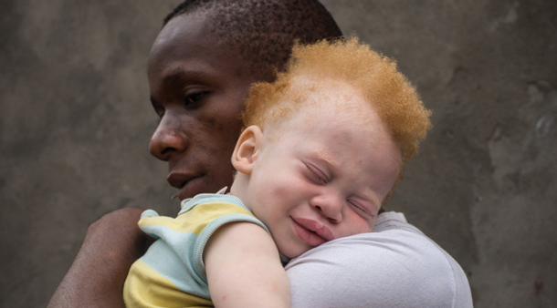 Warga Albino di Afrika Terus Dibantai, Organnya Digunakan untuk Ritual Ilmu Sihir